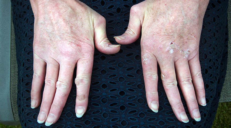 Hands of a Psoriatic arthritis (PsA) sufferer