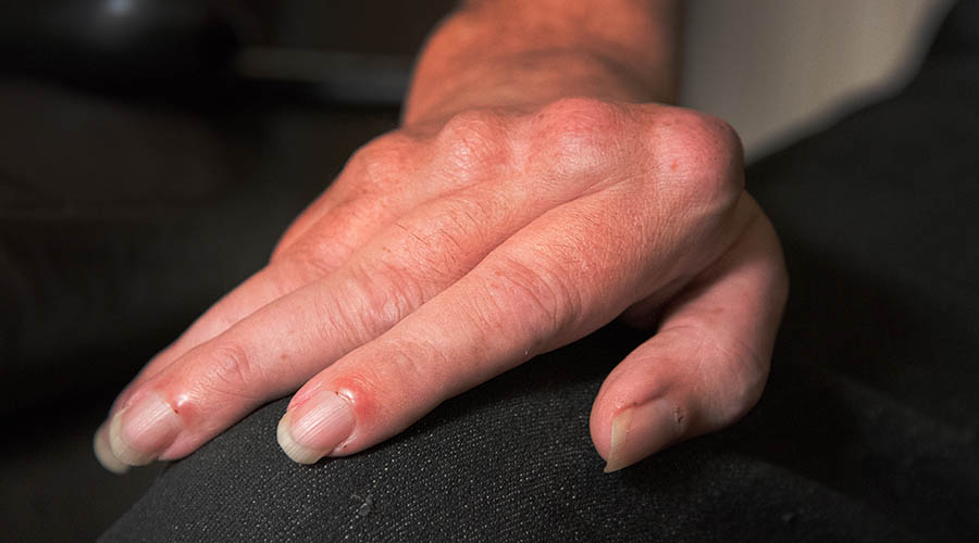 Hands of a rheumatoid arthritis sufferer
