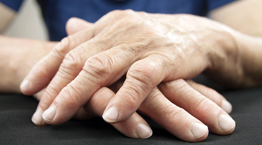 Hands of an arthritis sufferer